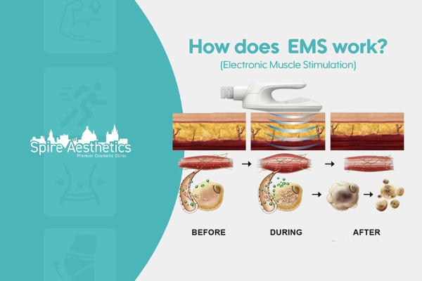 EMS treatment for post pregnancy weight loss treatment West Malling