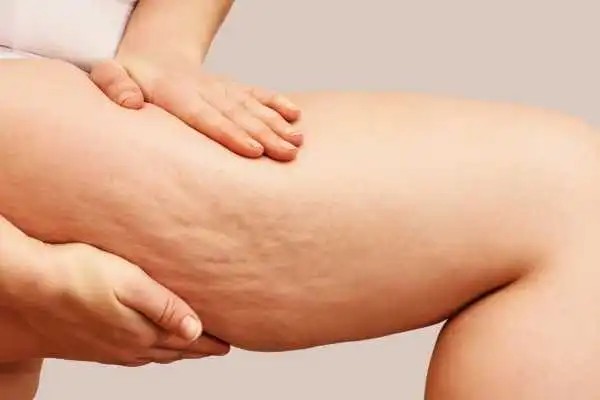 Image of woman showing leg with cellulite West Malling