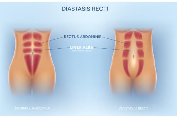 What Non-Surgical Options Are Available for Diastasis Recti West Malling?