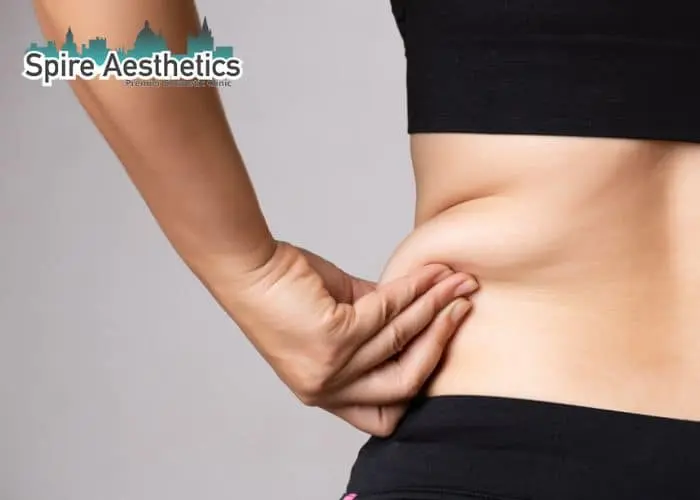 Image of woman pinching fat on their hips West Malling. Fat Freezing treatment