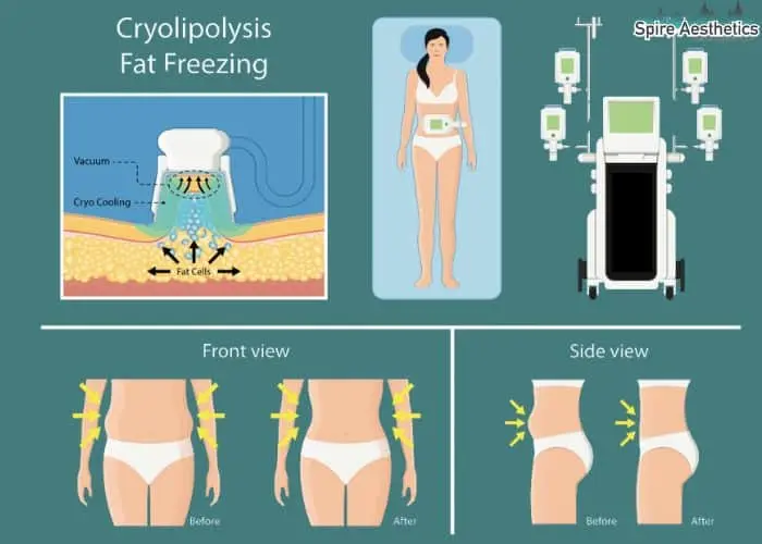 Fat freezing treatment West Malling benefits for competitions to remove stubborn fat deposits.