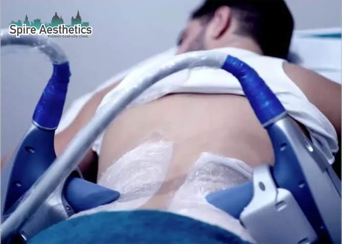 Man having fat freezing treatment done on love handles before a competitions West Malling to create a sculpted look.