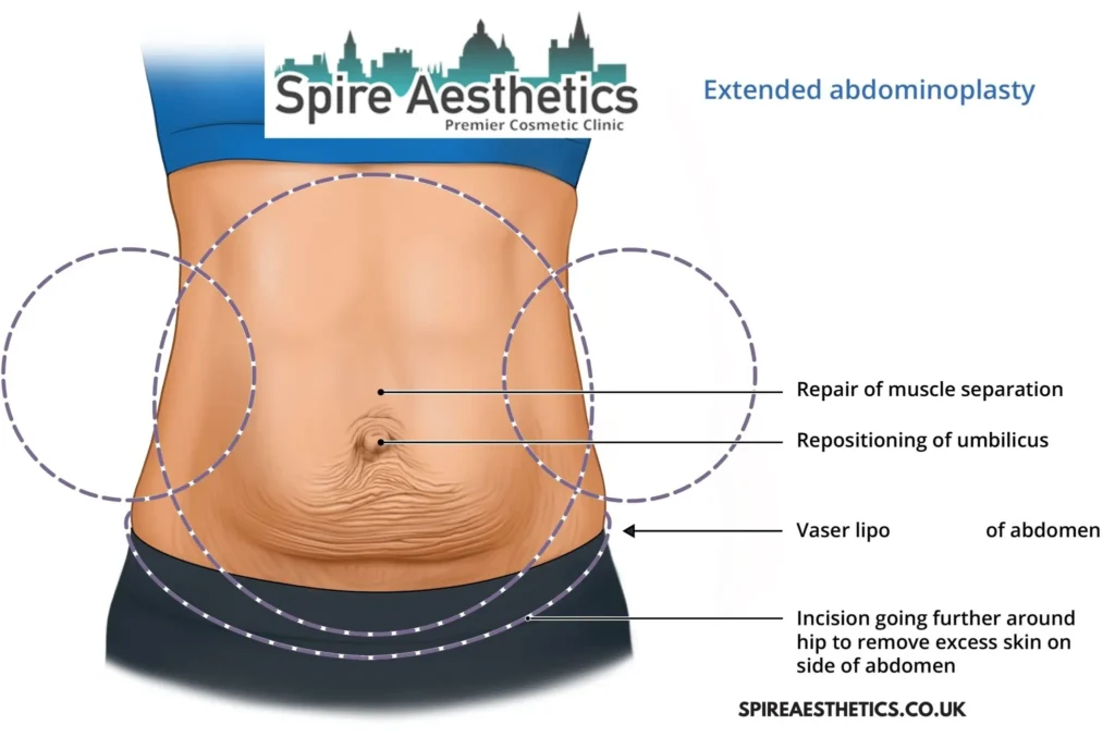 Understanding Loose Skin After Gastric Band West Malling Surgery and HIFU Treatment