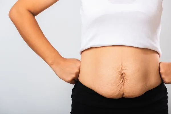 Image of a woman's stomach after weight loss with sagging skin following a gastric band West Malling