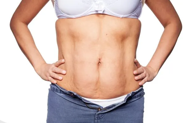 sagging skin on woman's stomach after weight loss injections West Malling