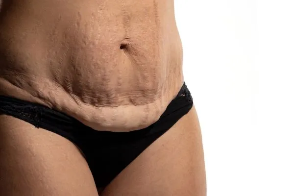 Image of womans stomach after weight loss injections West Malling showing saggy skin