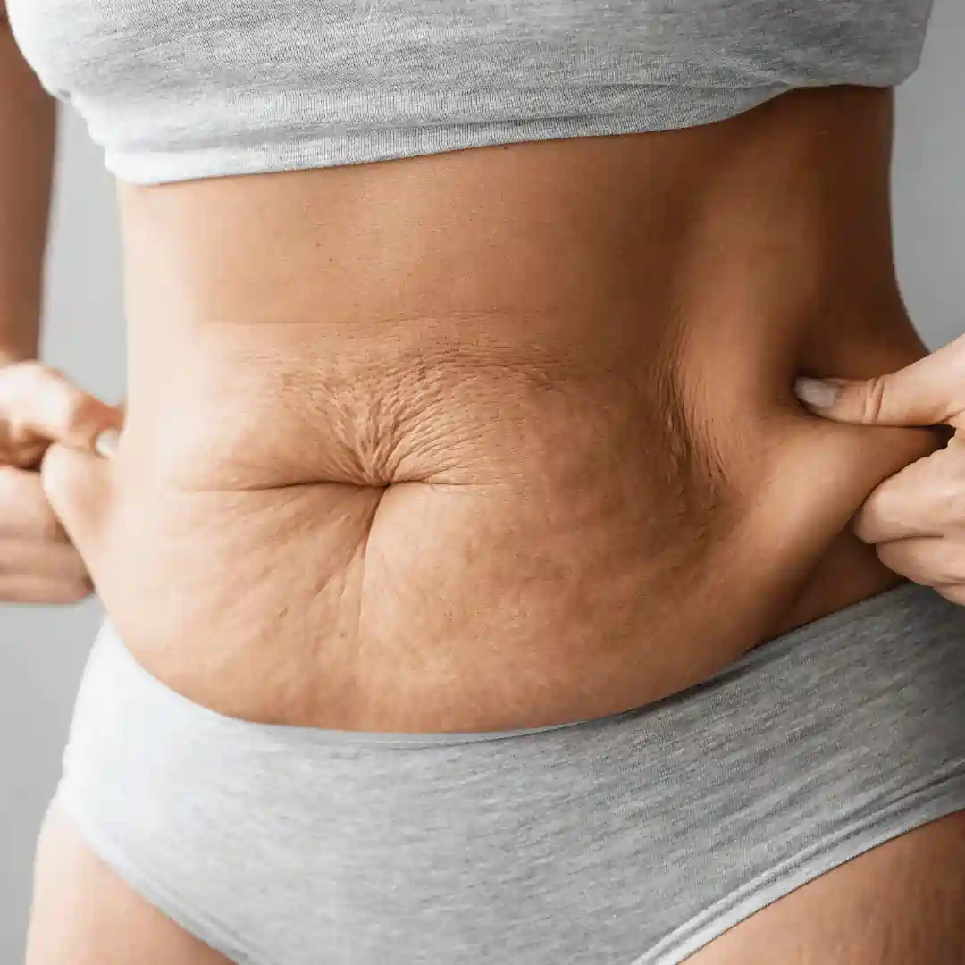 Is It Normal to Have Loose Skin After Pregnancy West Malling?