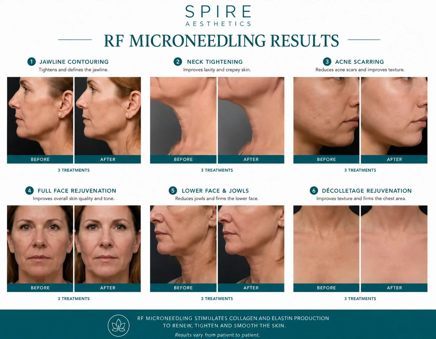 RF Microneedling Skin tightening West Malling results