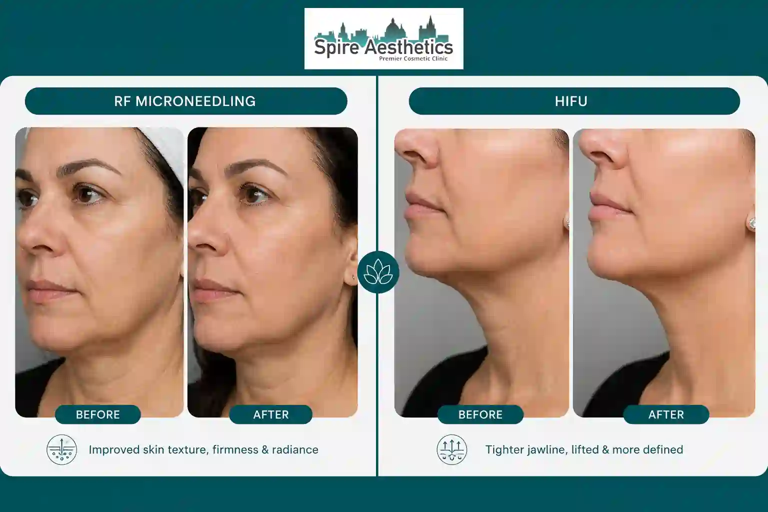 Can RF Microneedling and HIFU Be Combined West Malling?