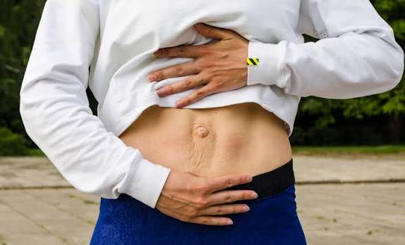 When Could Diastasis Recti Be the Missing Piece of the Puzzle West Malling?