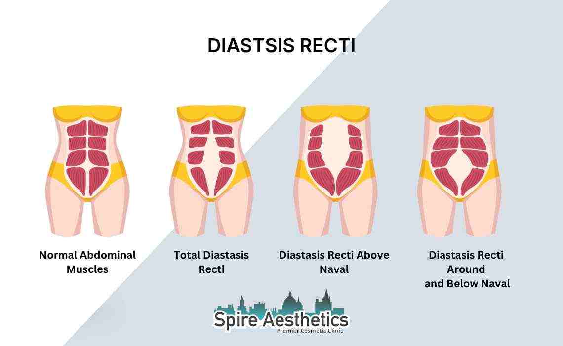 Is Non-Surgical Diastasis Recti Treatment Right for You? Common Concerns Answered West Malling